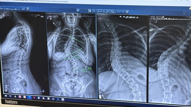 Le dépistage de la scoliose présente des lacunes au Québec